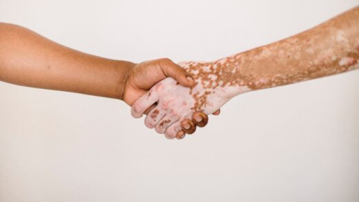 vitiligo itu apa